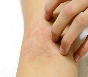 Atopický ekzém pod kontrolou: rady a tipy od dermatoložky