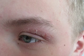 Vliv stravování na kožní nemoci z pohledu nutriční terapeutky